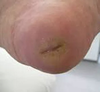 Closed heal wound after ETI Wound Healing Center