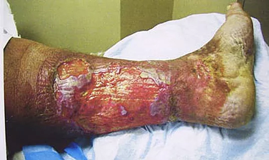 Diabetic male with severe leg wounds before ETI