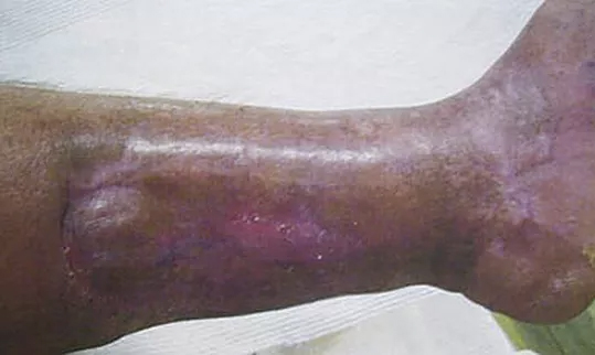 Successful healing results after ETI treatment