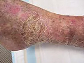 Severe foot rash - before ETI Wound Healing
