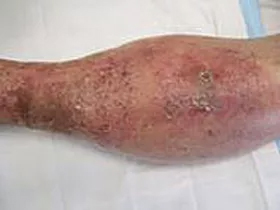 Severe leg rash - before ETI Wound Healing