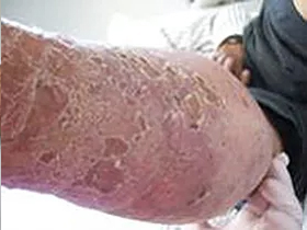 Peeling leg rash - before ETI Wound Healing
