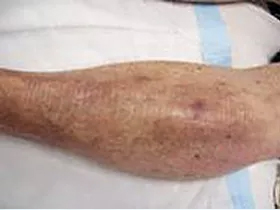 Healing leg rash - after ETI Wound Healing
