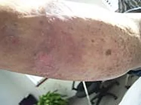 Close up of healing rash - after ETI Wound Healing Center