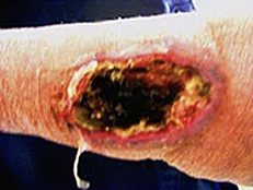 Exposed non-healing knee wound - before ETI