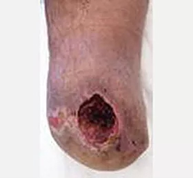 Diabetic male with open ankle wound